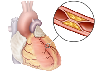 Diabète et risque cardiovasculaire : Le coronarien diabétique