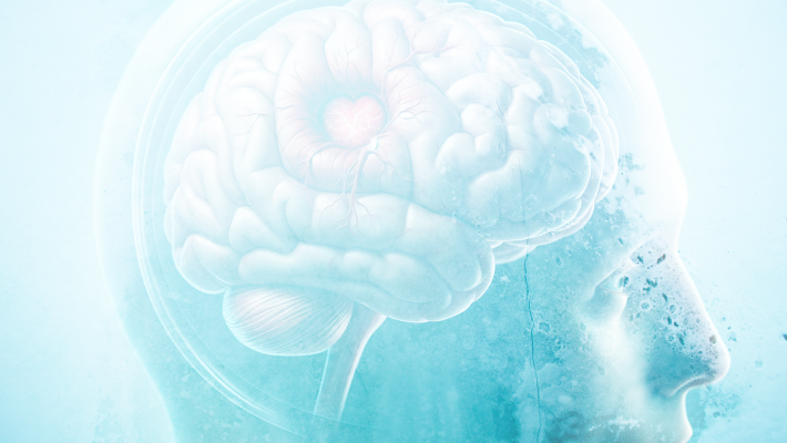 Infarctus cérébral : c’est quoi ?